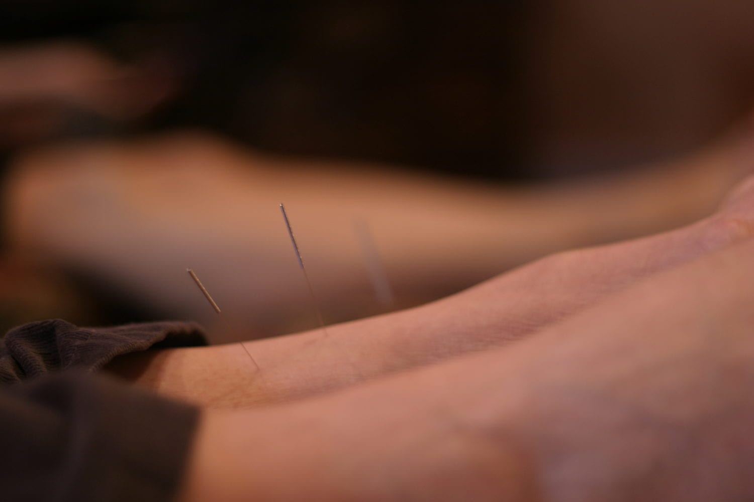 Is Dry Needling or Acupuncture Better For Me?